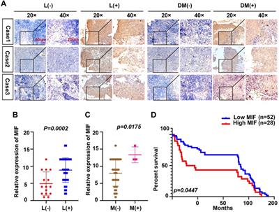 Exosomal MIF Derived From Nasopharyngeal Carcinoma Promotes Metastasis by Repressing Ferroptosis of Macrophages